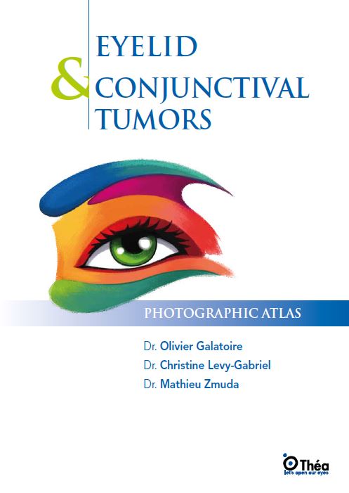Eyelid___Conjunctival_Tumors